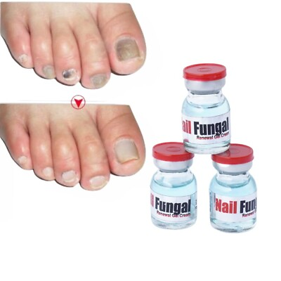 #ad AdiExpress Foot nail serum fungal Infection Nail treatment Free Shipping $19.99